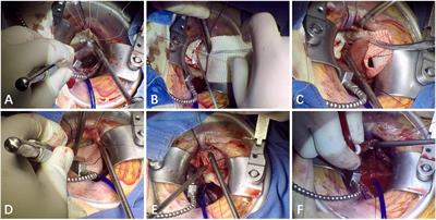 Mini-Invasive Bentall Procedure Performed via a Right Anterior Thoracotomy Approach With a Costochondral Cartilage Sparing